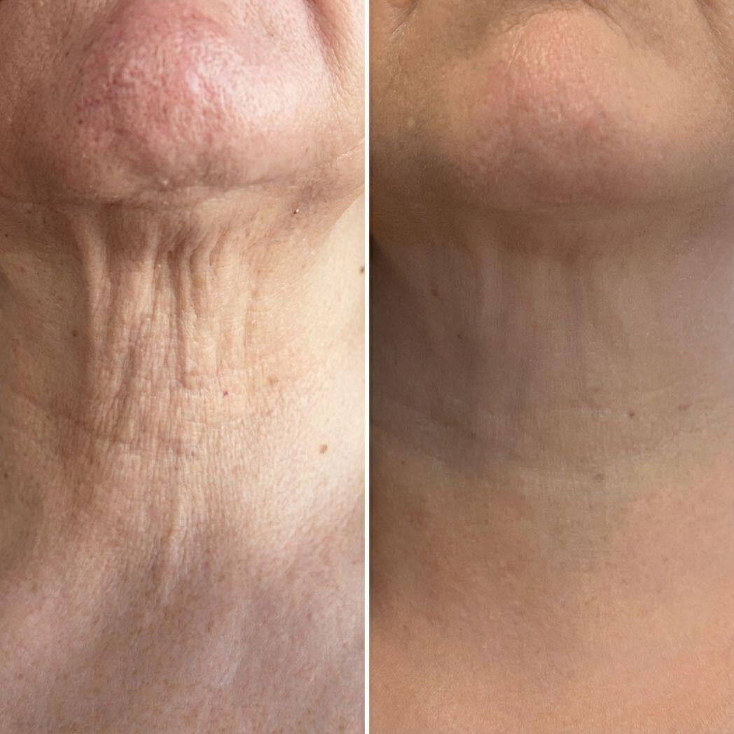 Rodillo 3D Reafirmante – Masajeador Facial y de Cuello Efecto Lifting